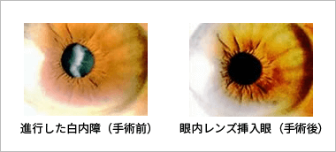 進行した白内障と眼内レンズ挿入眼